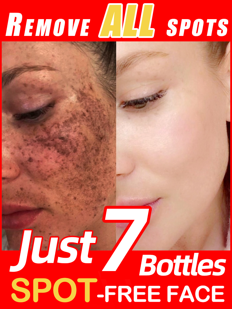 Skincare Luxury Whitening - Schiarire le lentiggini Melasma, macchie scure